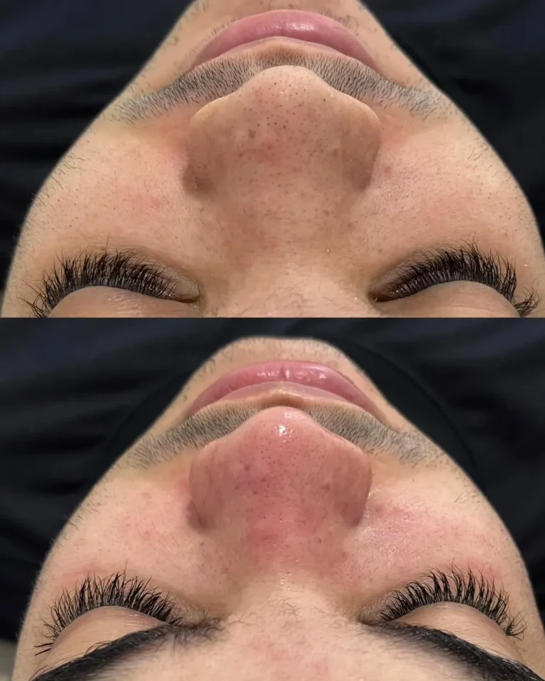 antes depois 1