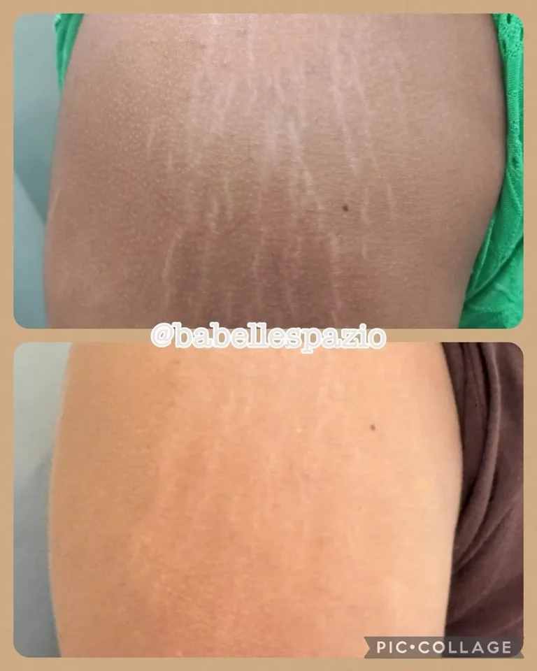 antes depois 2
