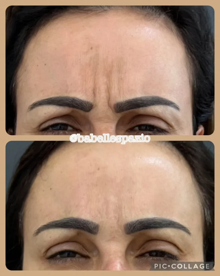 antes depois 3